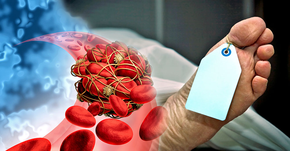 blood clots embalmer report