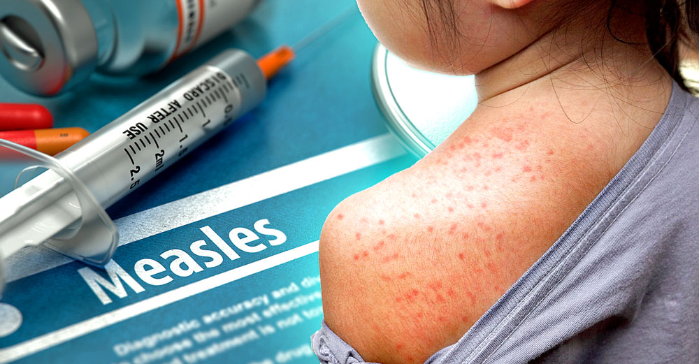 maine measles vaccine induced