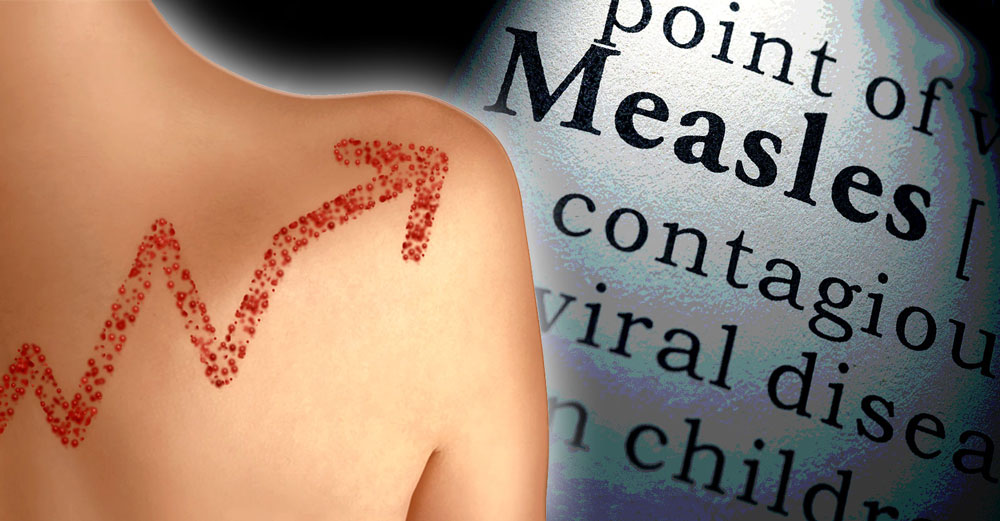 measles cases rise